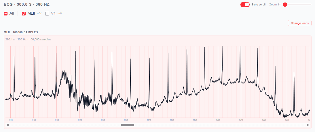 ECG waveform for MIT-BIH 101