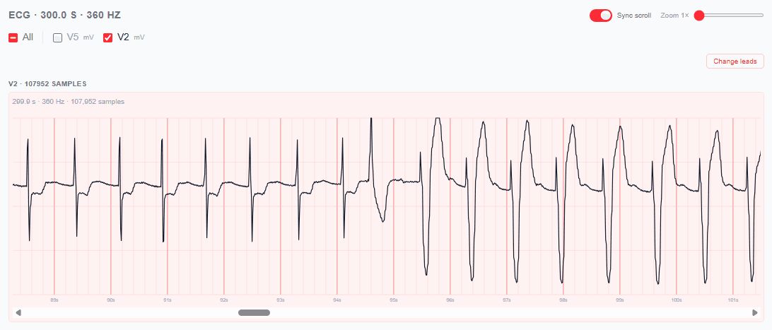 ECG waveform for MIT-BIH 102