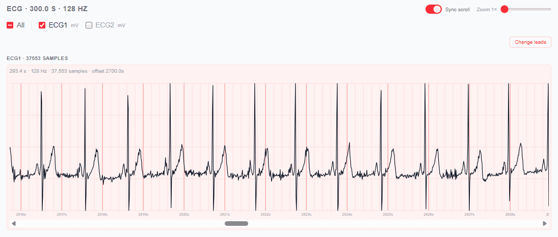 ECG waveform for MIT-BIH 16272