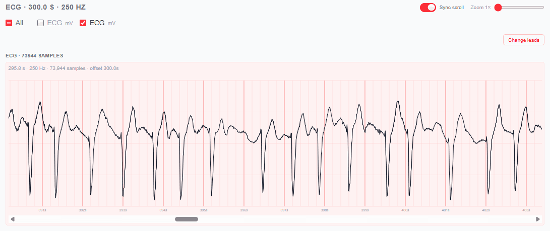 ECG waveform for SDDB 35